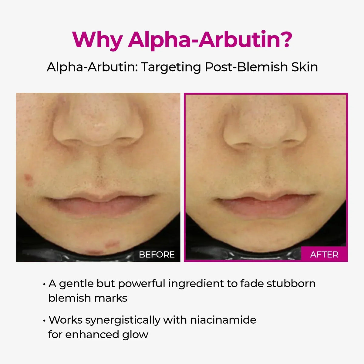 Alpha-Arbutin before and after on post-blemish marks