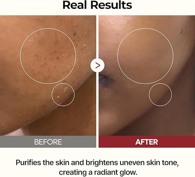 Rice Peel Ampoule real results — brighter, more even skin